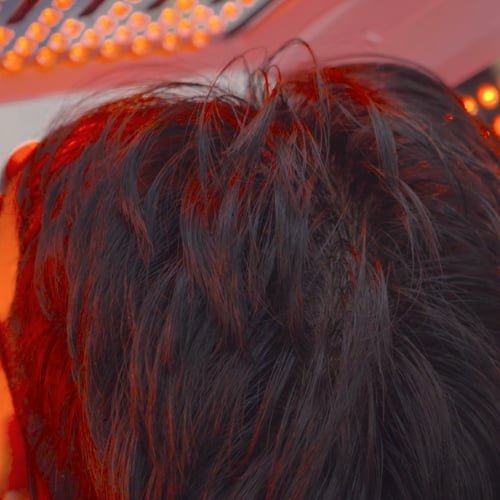 Hair Growth with Salmon Sperm PDRN at The Better Face