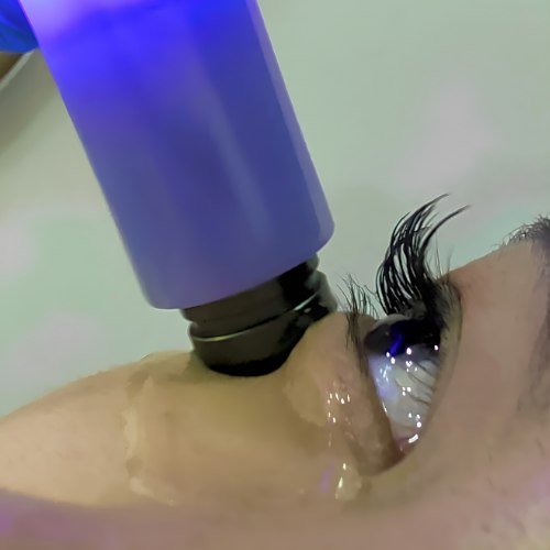 An Exilis handpiece in use on the skin beside a client's eye