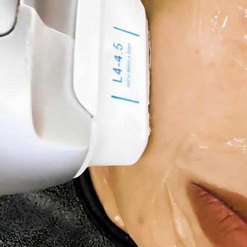 A HIFU cartridge held against a client's jawline during a skin-tightening session